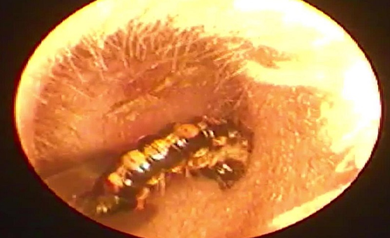 Врач обнаружил червя в ухе своего пациента, который за несколько дней смог построить там гнездо